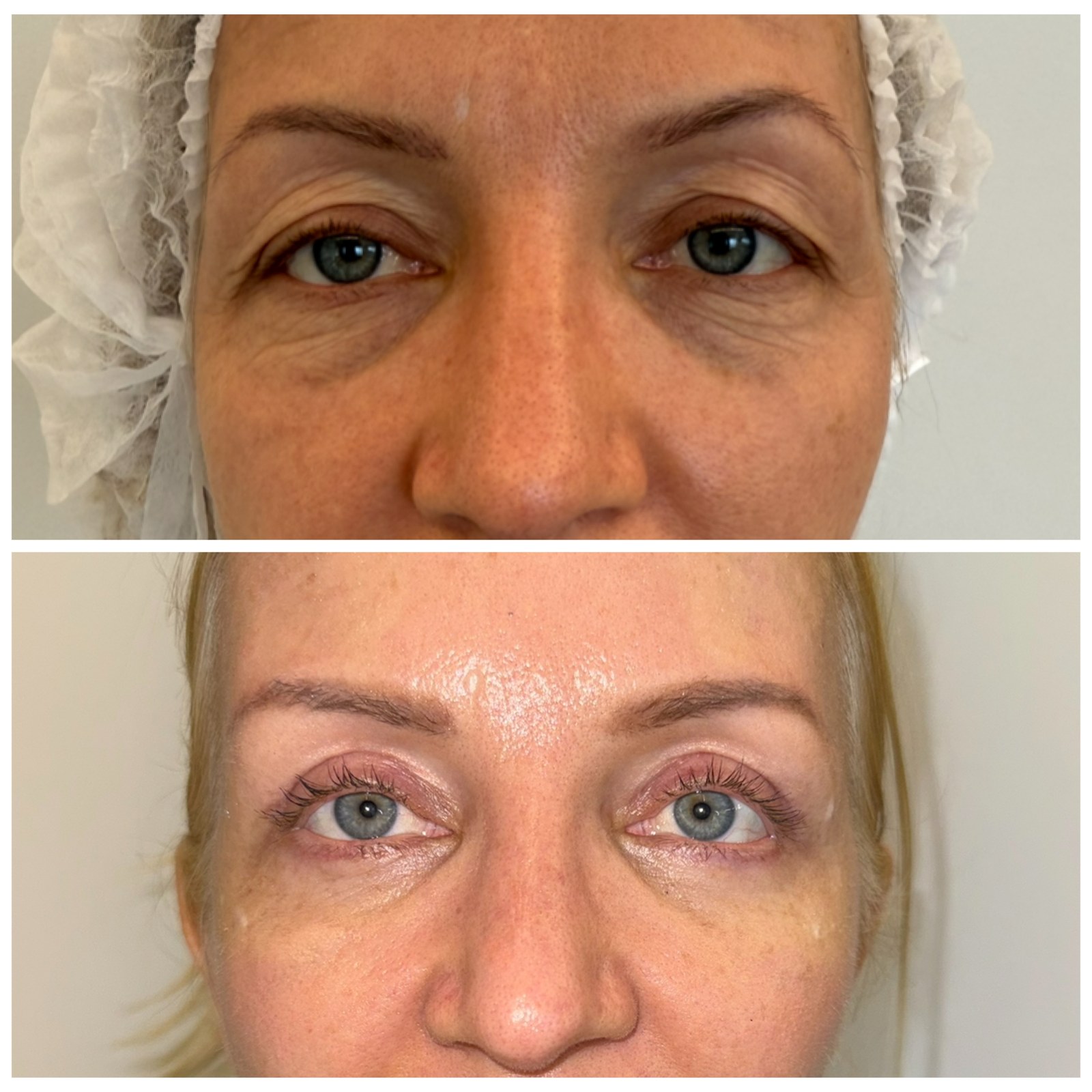 Antes e depois Blefaroplastia Dra. Bianca Barreto