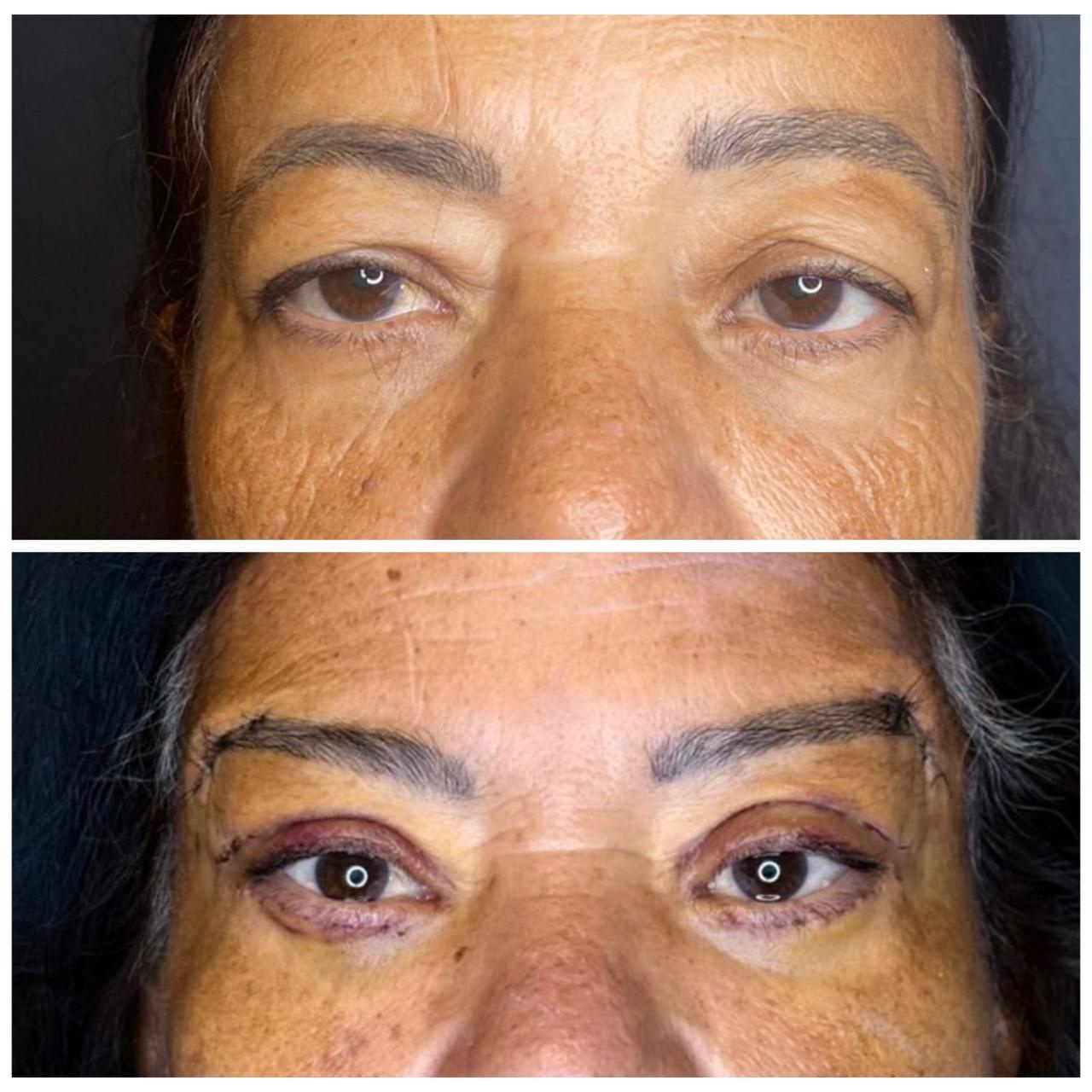 Caso Clínico 04 Blefaroplastia e Lift de Sobrancelhas Dra. Bianca Barreto