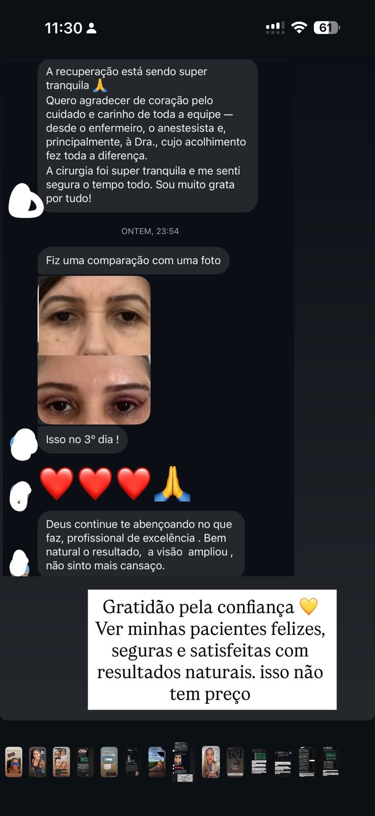 Comparação fotográfica no 3º dia de recuperação Dra. Bianca Barreto