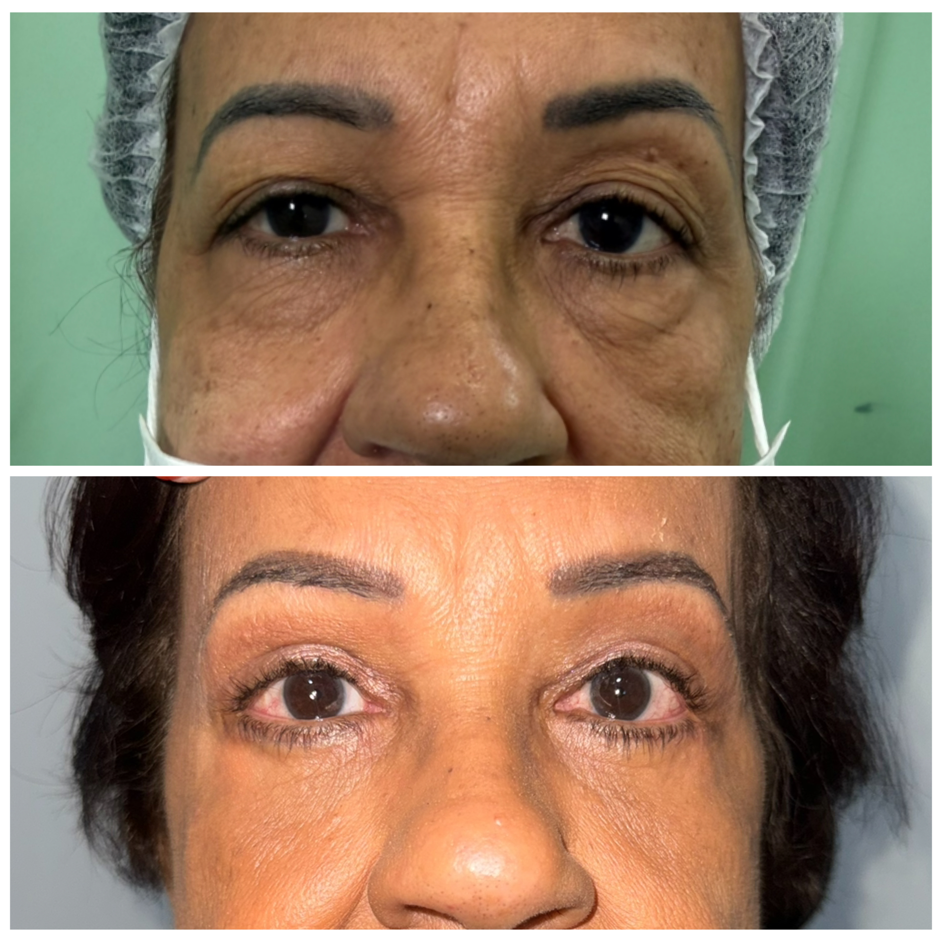 Antes e depois Blefaroplastia Superior e Inferior Dra Bianca Barreto