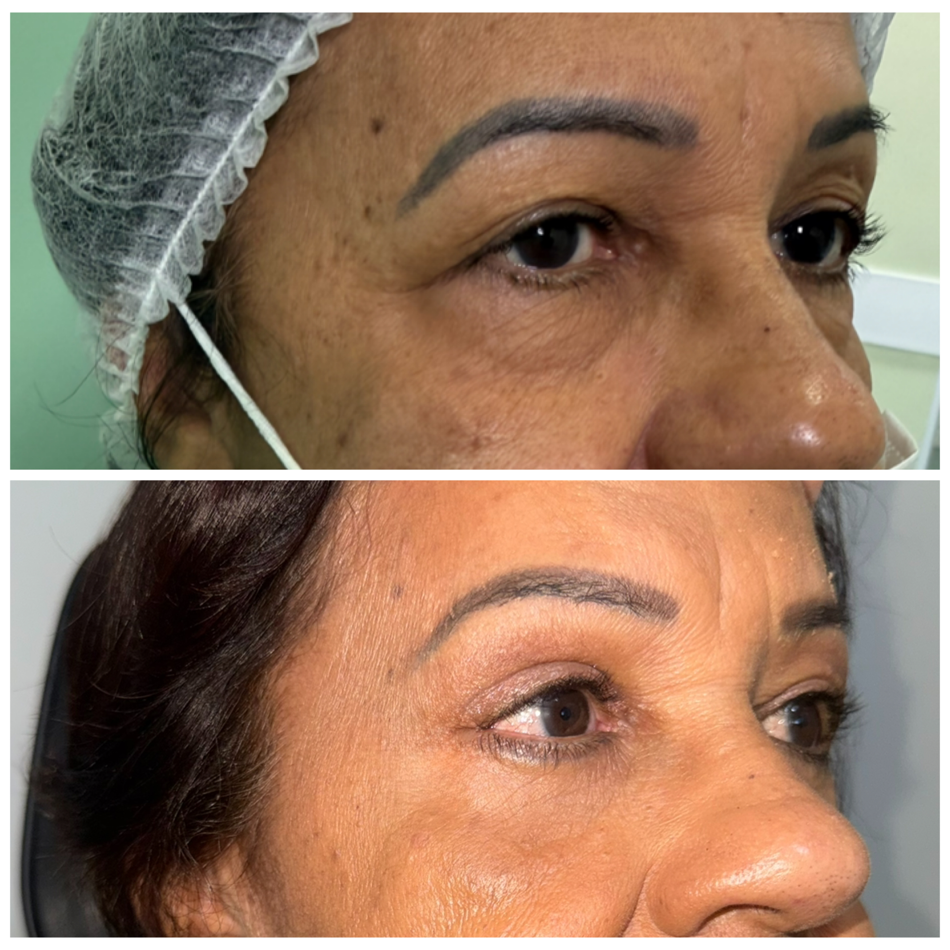 Antes e depois ângulo oblíquo Dra Bianca Barreto