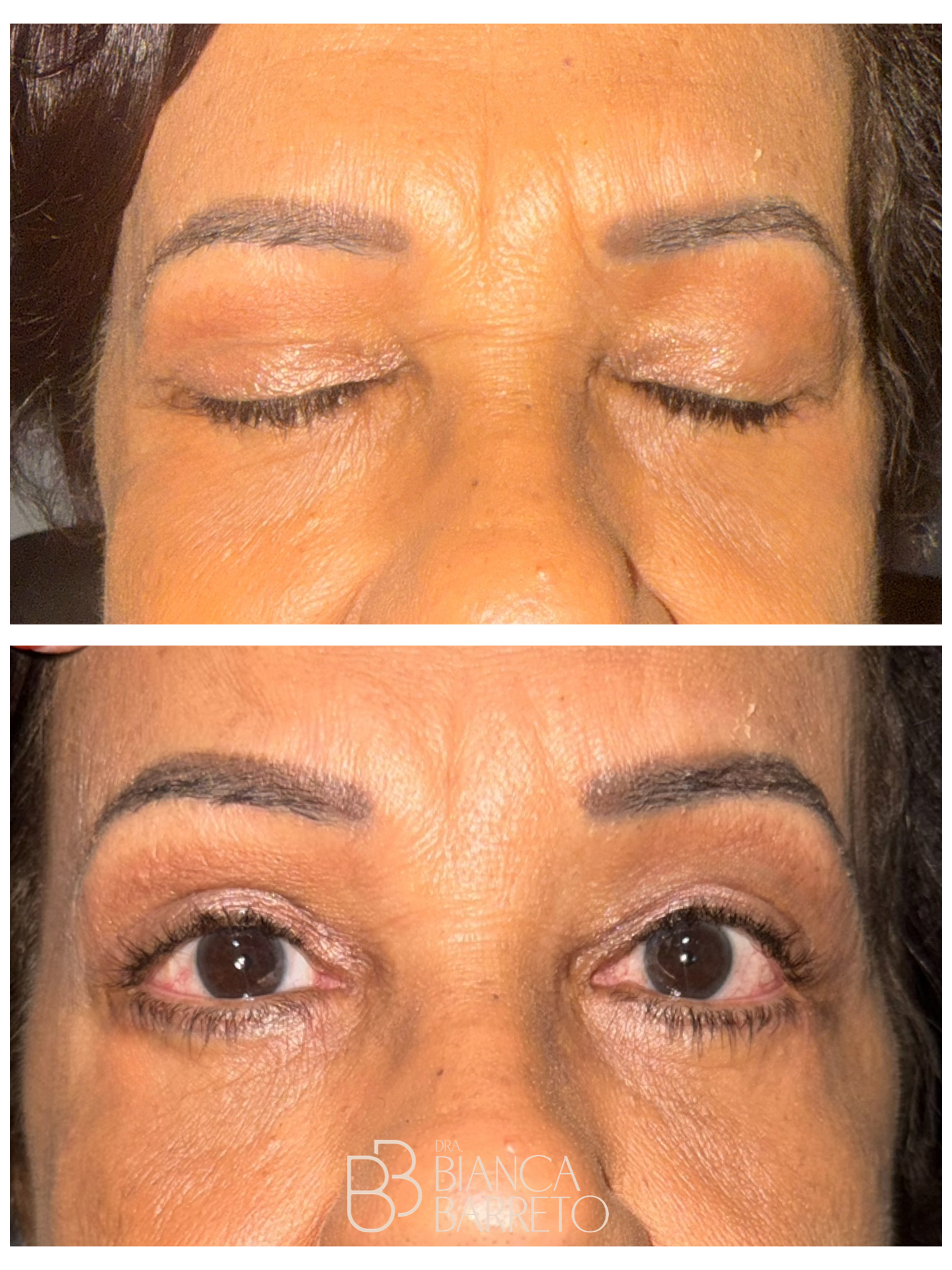 Cicatriz imperceptível e fechamento perfeito Dra Bianca Barreto