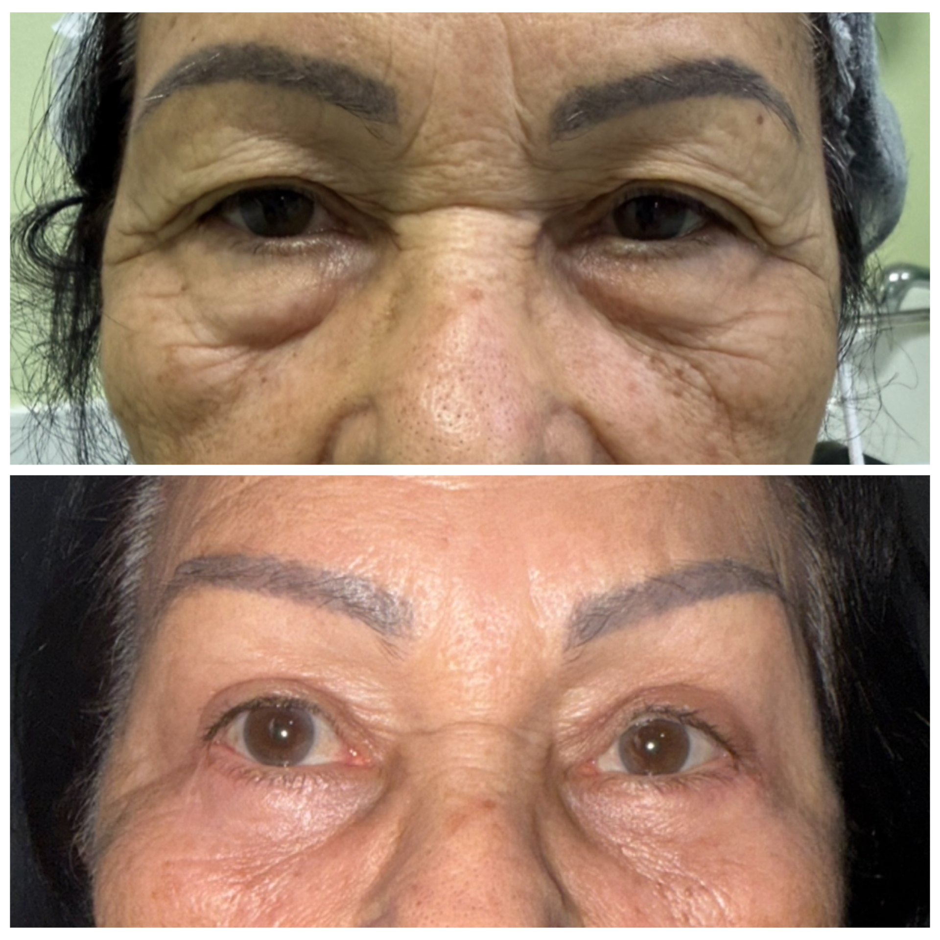 Firmeza periocular e rejuvenescimento Dra Bianca Barreto