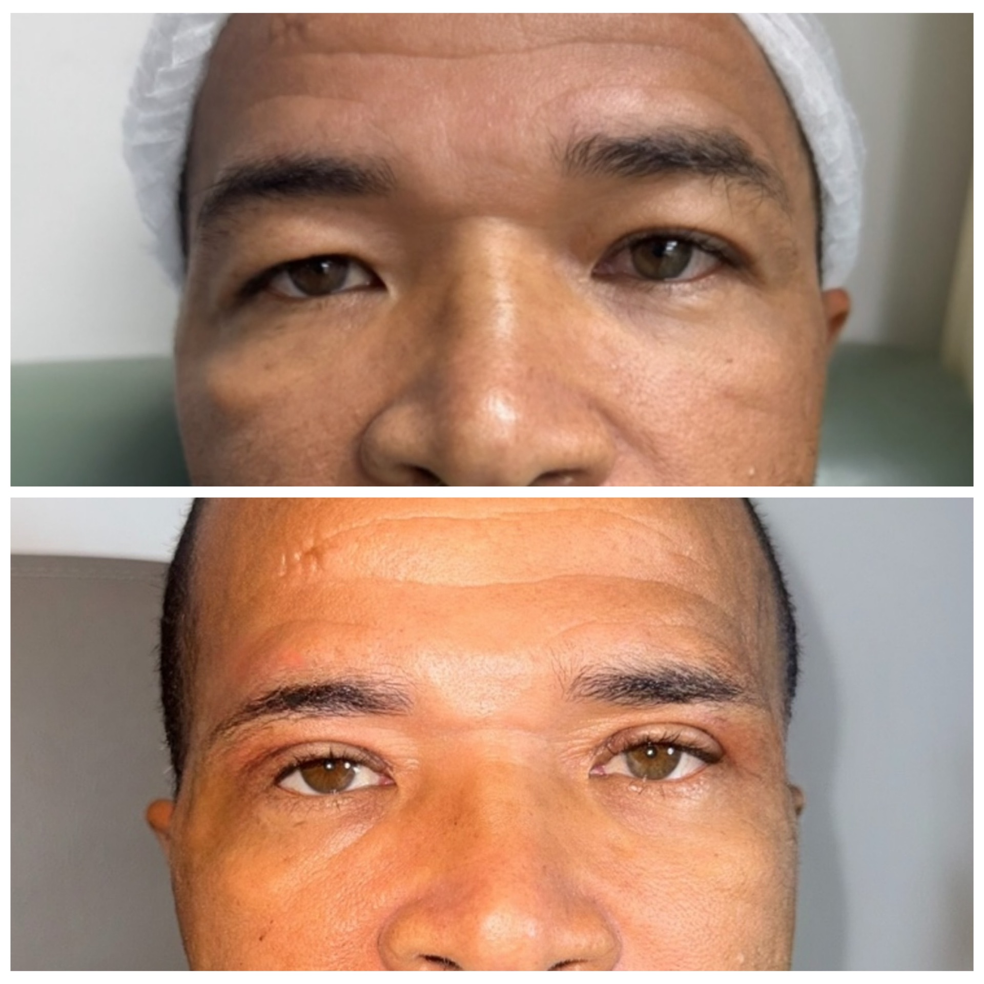 Blefaroplastia masculina a laser Dra Bianca Barreto